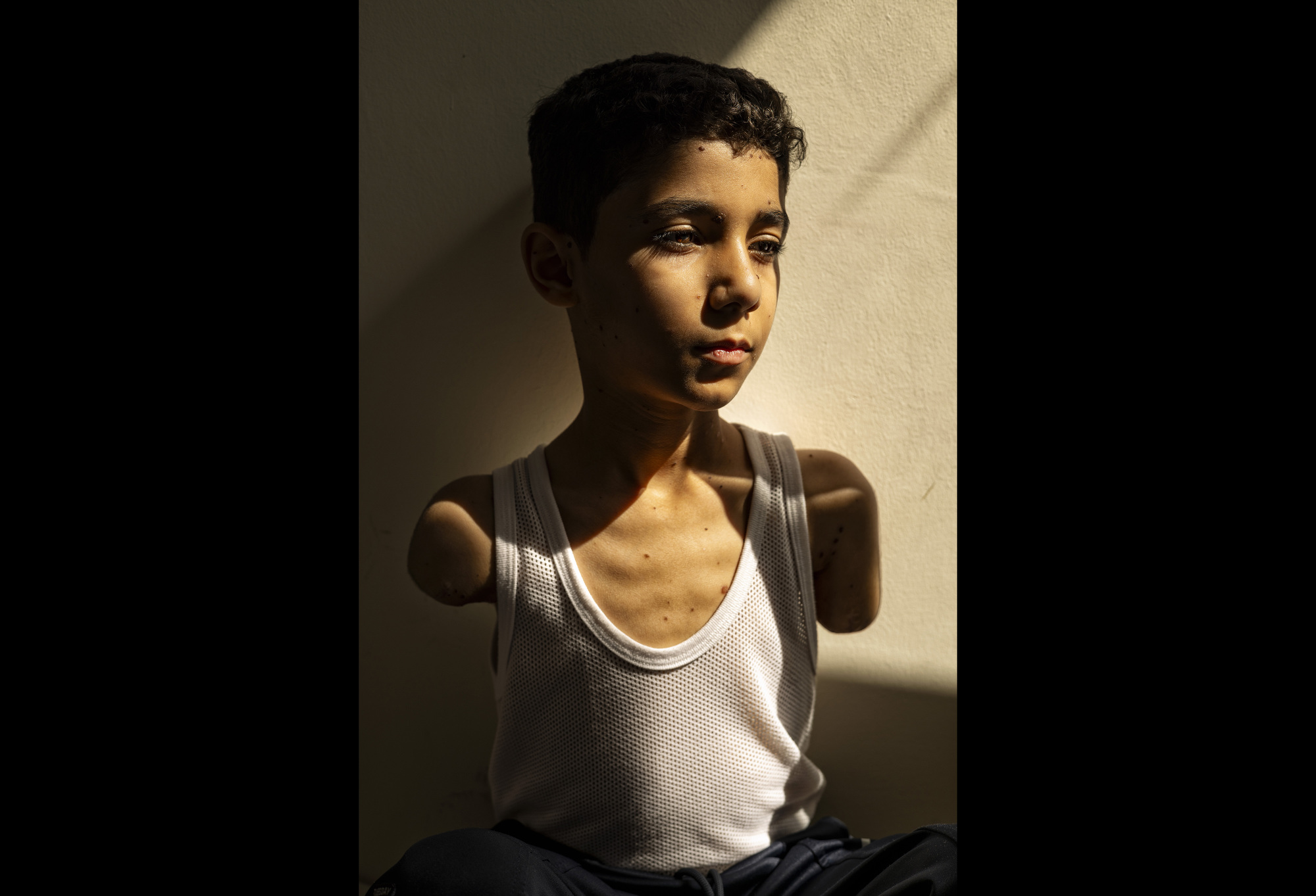 2025年世界新聞攝影獎年度圖片大獎公布，由《紐約時報》（The New York Times）巴勒斯坦籍攝影師Samar Abu Elouf所拍攝的肖像照，一名年輕男童在逃離加薩戰火時嚴重受傷、遭受截肢，畫面震撼人心。（攝影／Samar Abu Elouf／The New York Times）